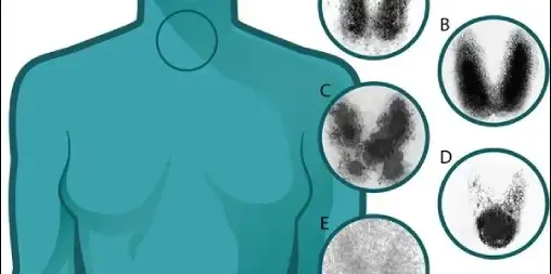 Thyroid scan and uptake